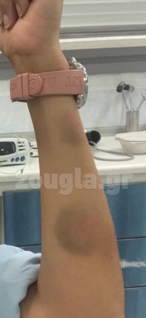 τζουλη βραχιονας μπραβος μαρινακη